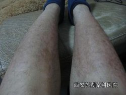 分型不同的银血病有什么症状